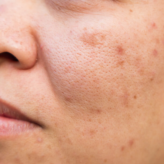 Adult acne on a cheek
