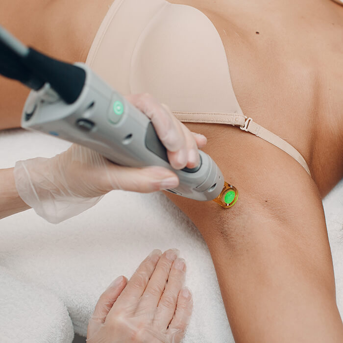 women gets under arm laser hair treatment
