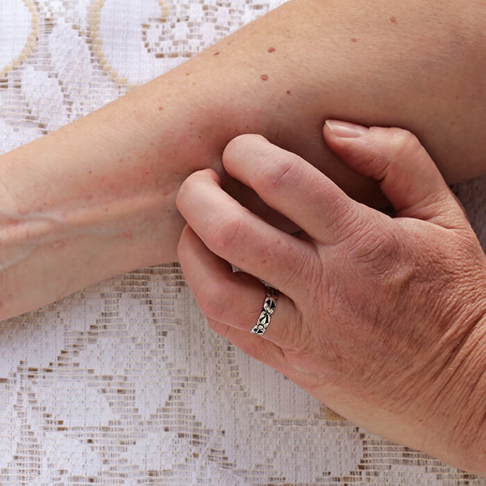 woman scratching dry skin