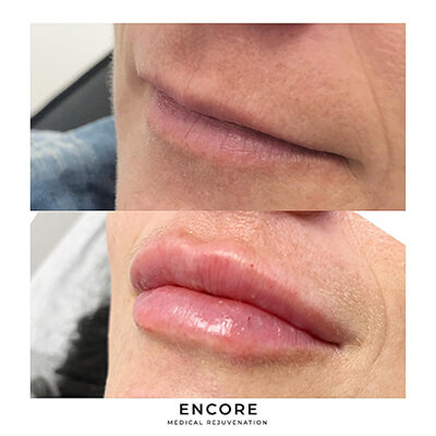 Before & After: Lip Filler Injections