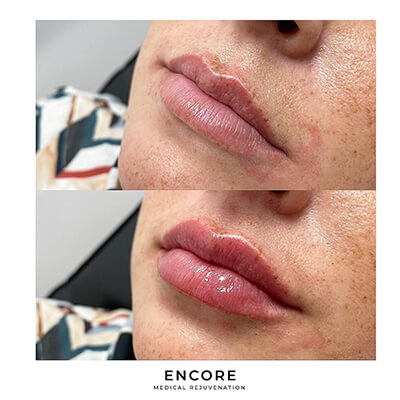 Before & After: Lip Filler Injections