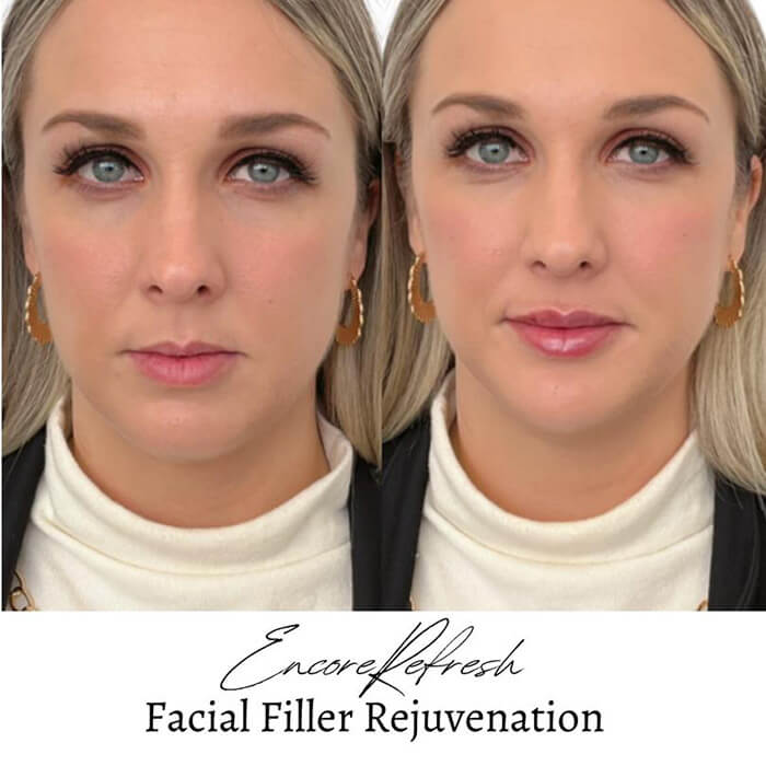 Before and After of chin fillers by Encore Medical Rejuvenation