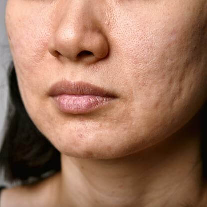 client received acne laser treatment