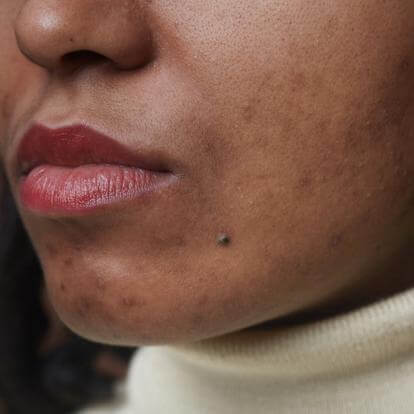 client with acne scarring