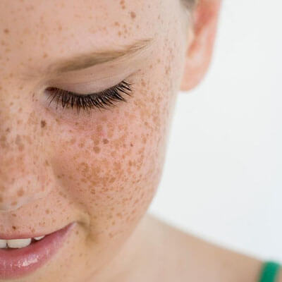 Young woman has her freckles treated at Encore Medical Rejuvenation