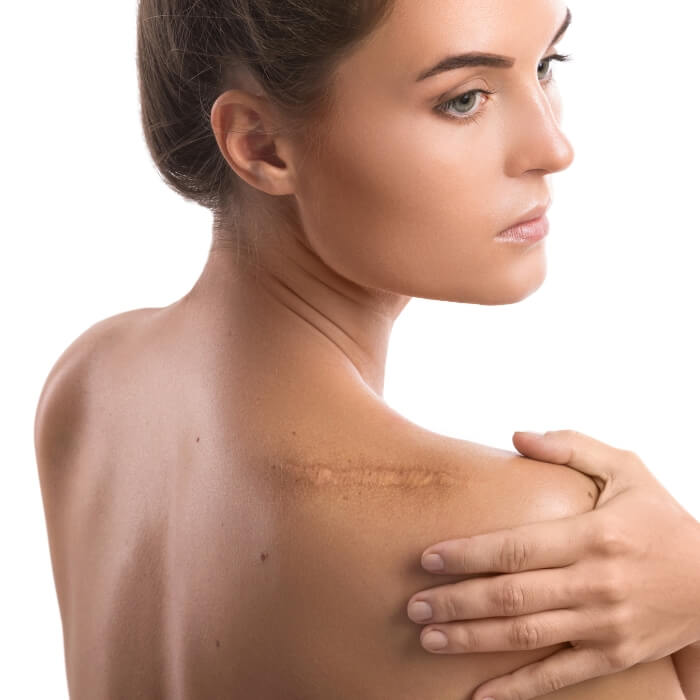 shoulder scar being assessed for removal at Encore Medical Rejuvenation