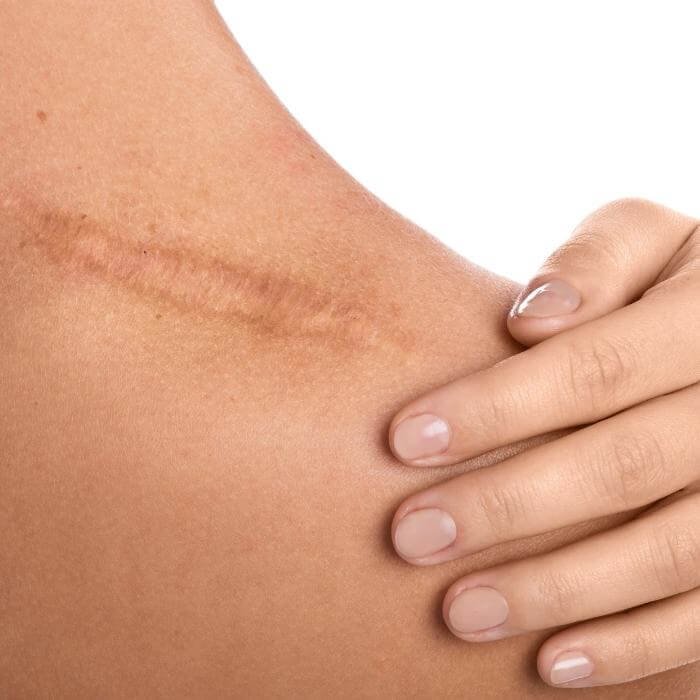 Laser Scar Treatment